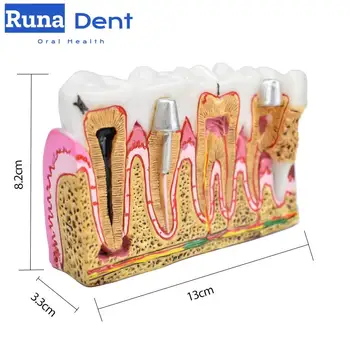 Анатомия на зъбите Модел на устната кухина при кариесе Комплексна патология на нерв на зъб Модел зъб за обучение на устната кухина Инструмент за зъби